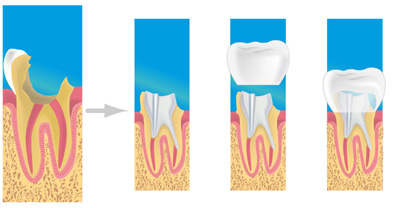 prothese dentaire paris 11
